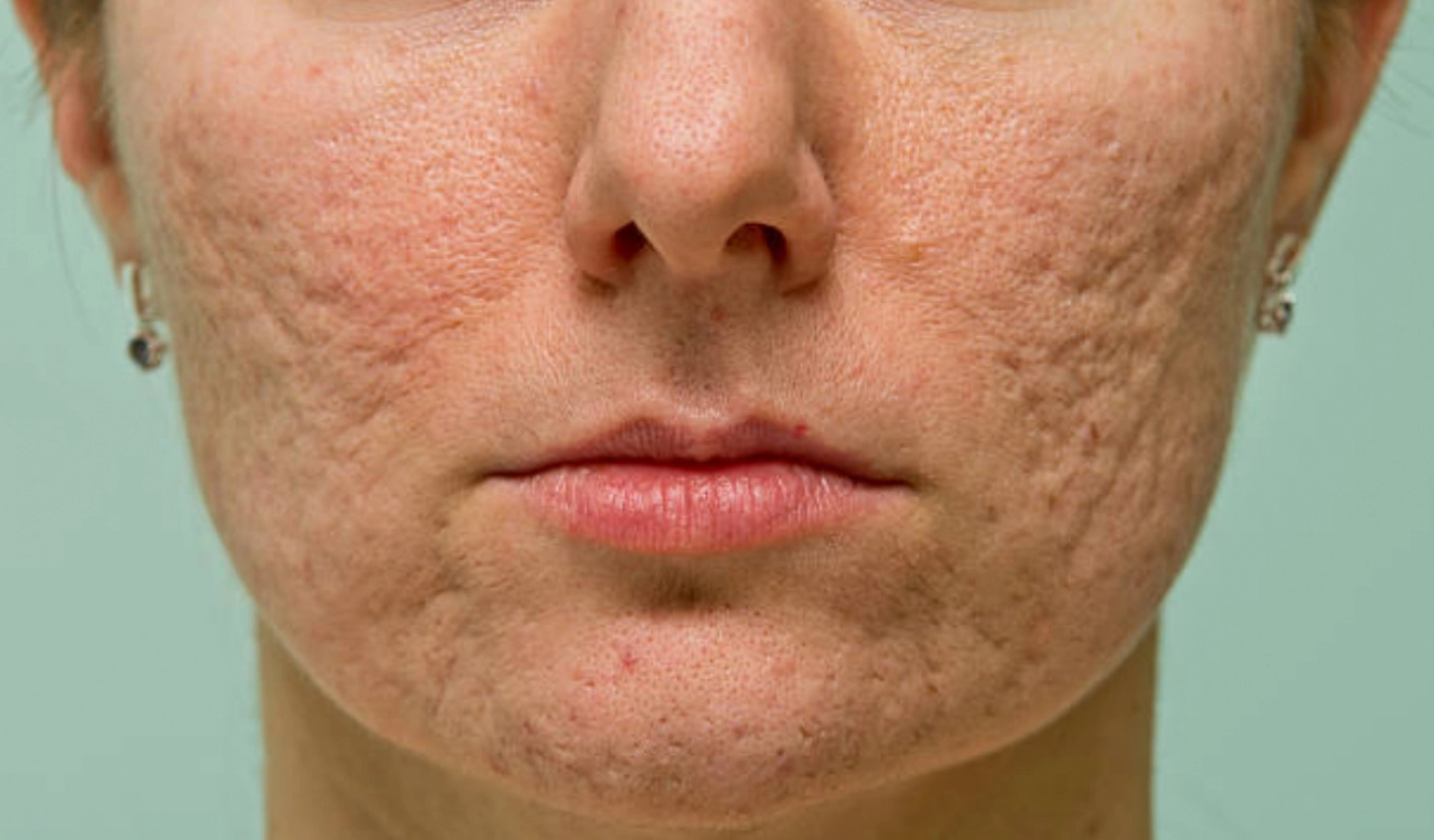 2921litteken-acne.jpg