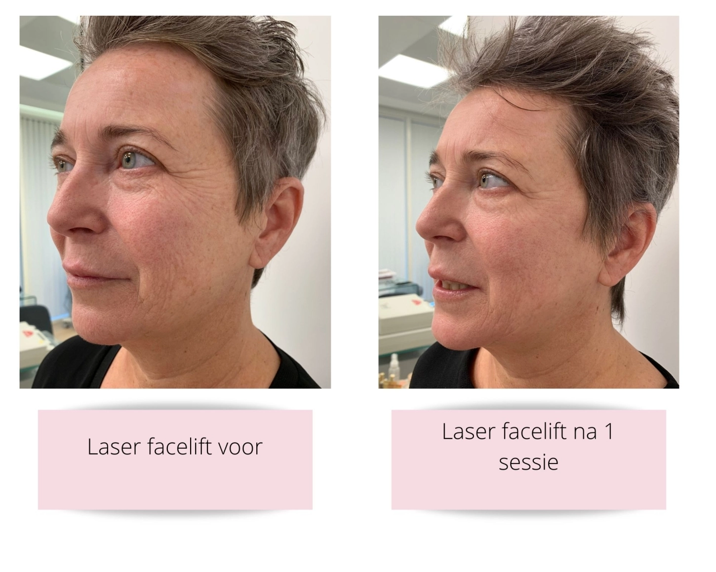 15241laser-facelift-voorna.jpg