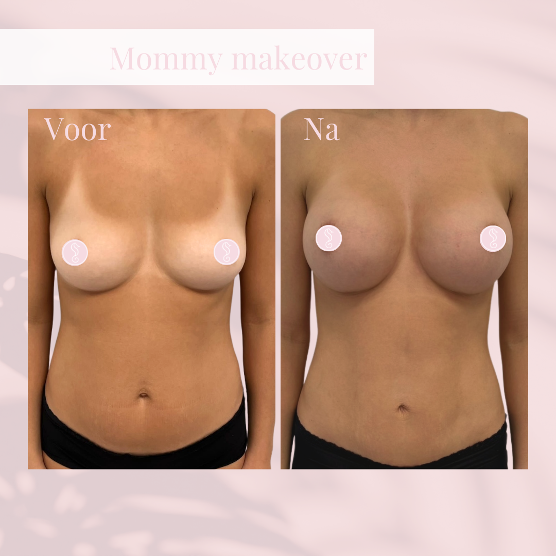 BA mentor 300 full+ mini-buikcorrectie + lipo - LD BA mentor 300 full+ mini-buikcorrectie + lipo - LD