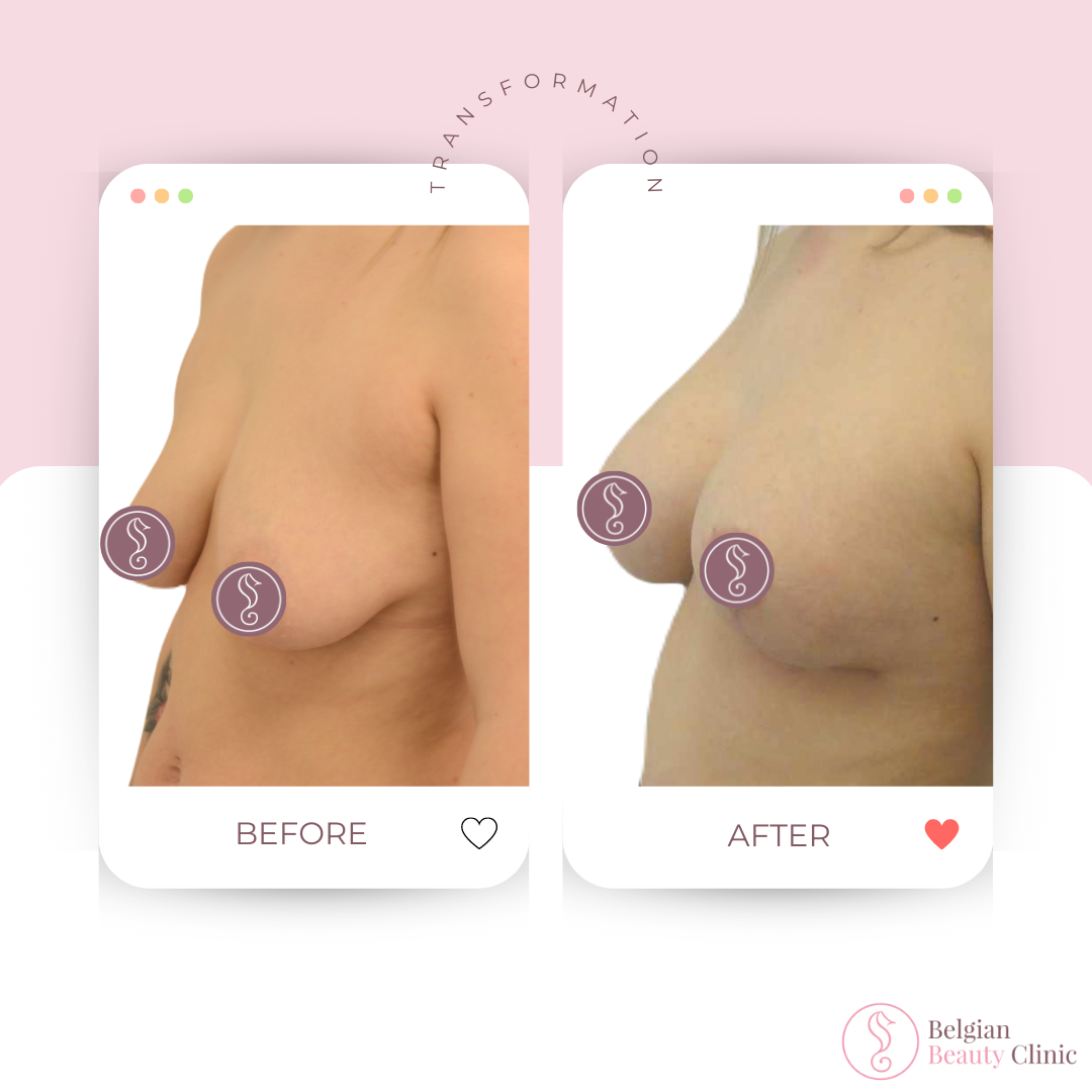 Borstlift met implantaten 001 Borstlift met implantaten 001