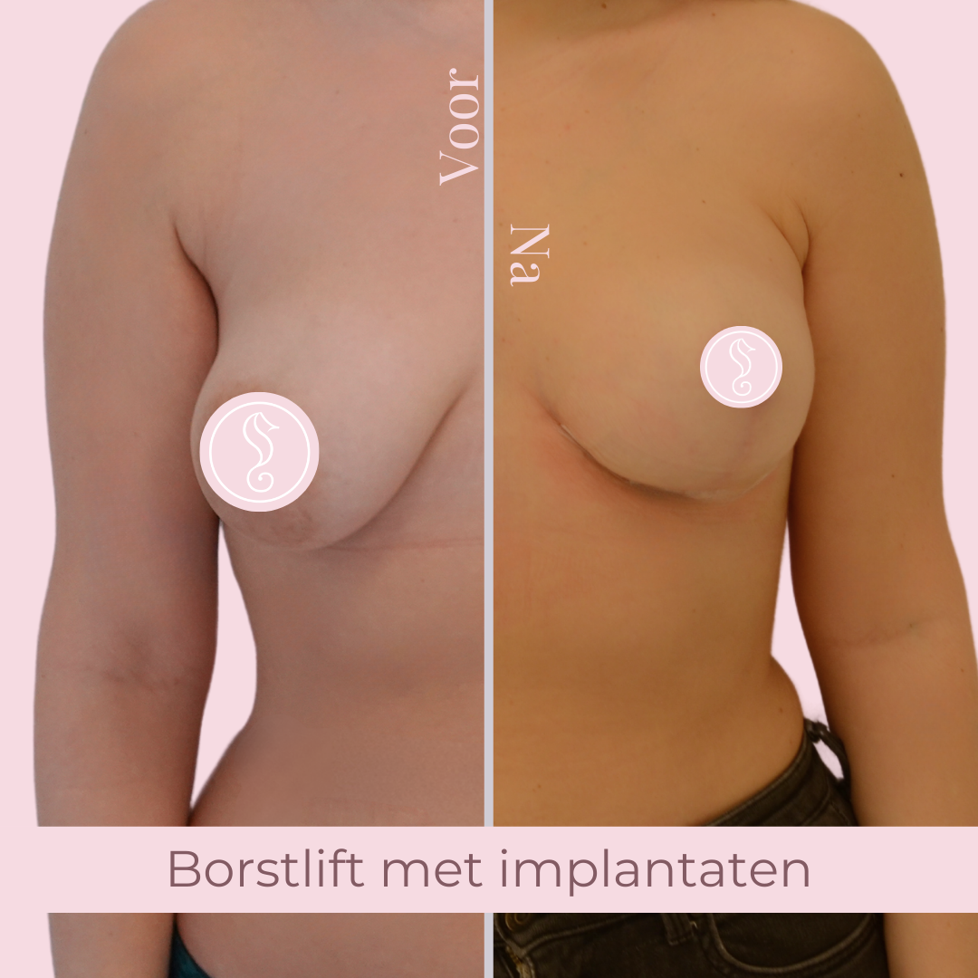 Borstlift met implantaten Mentor 300 Borstlift met implantaten Mentor 300