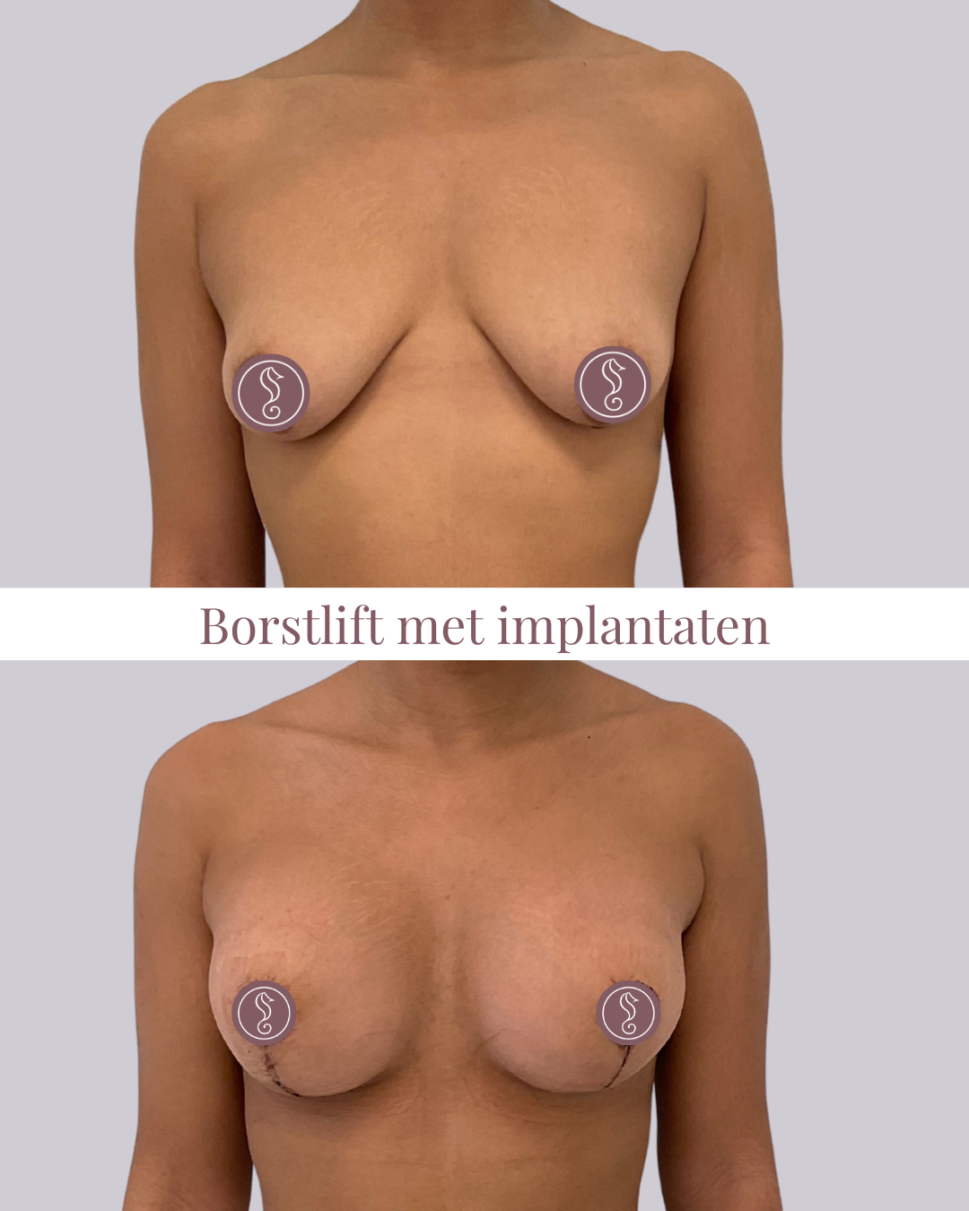 Borstlift met implantaten prog + full 315 Borstlift met implantaten prog + full 315