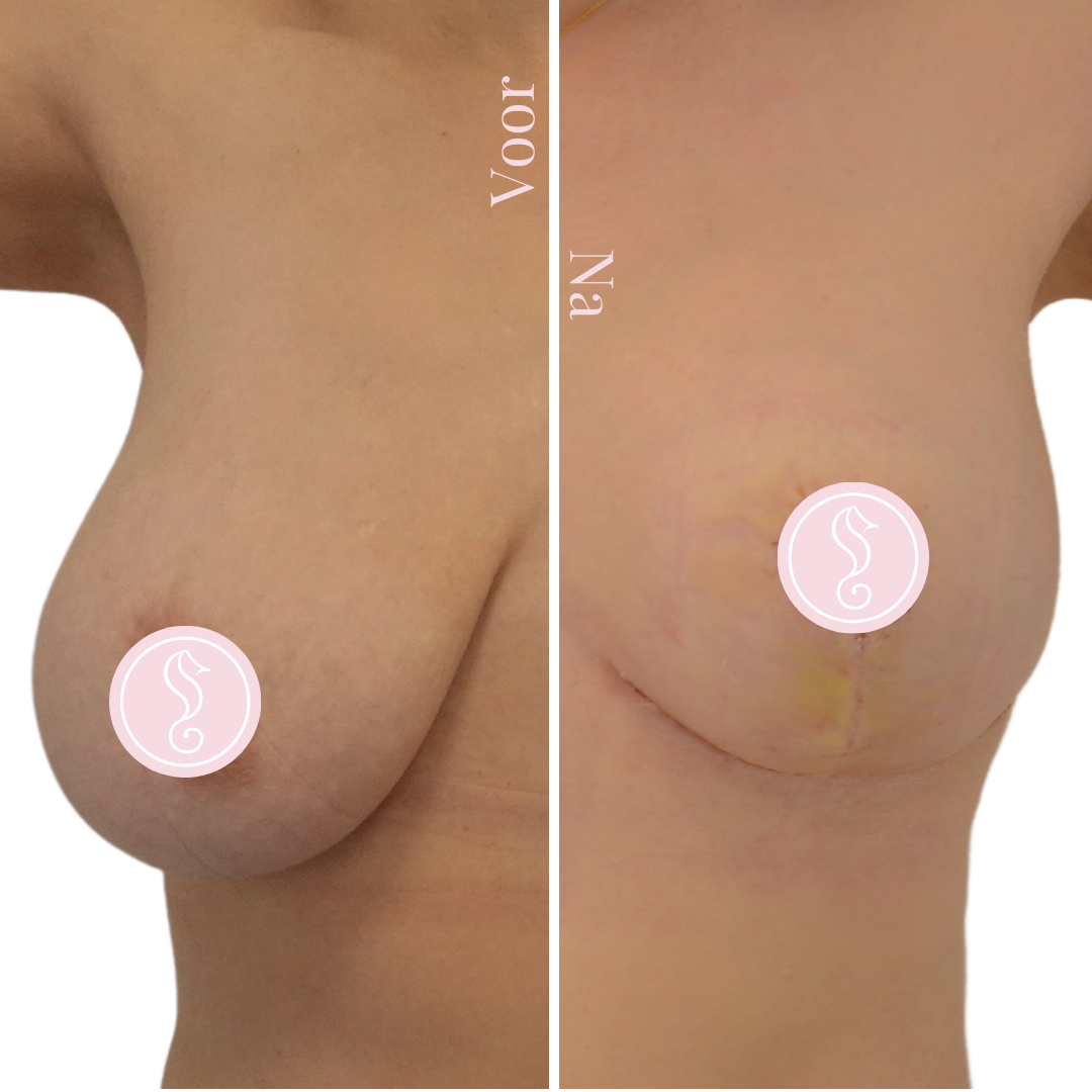 Bortslift met implantaten prog + demi 265cc - LD Bortslift met implantaten prog + demi 265cc - LD