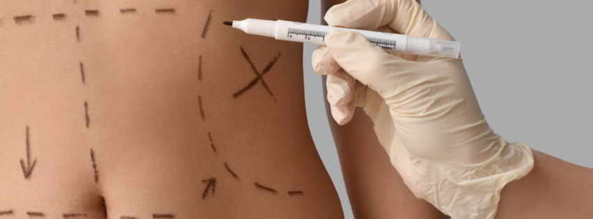 a surgeon marking the places of incision on the stomach of his patient