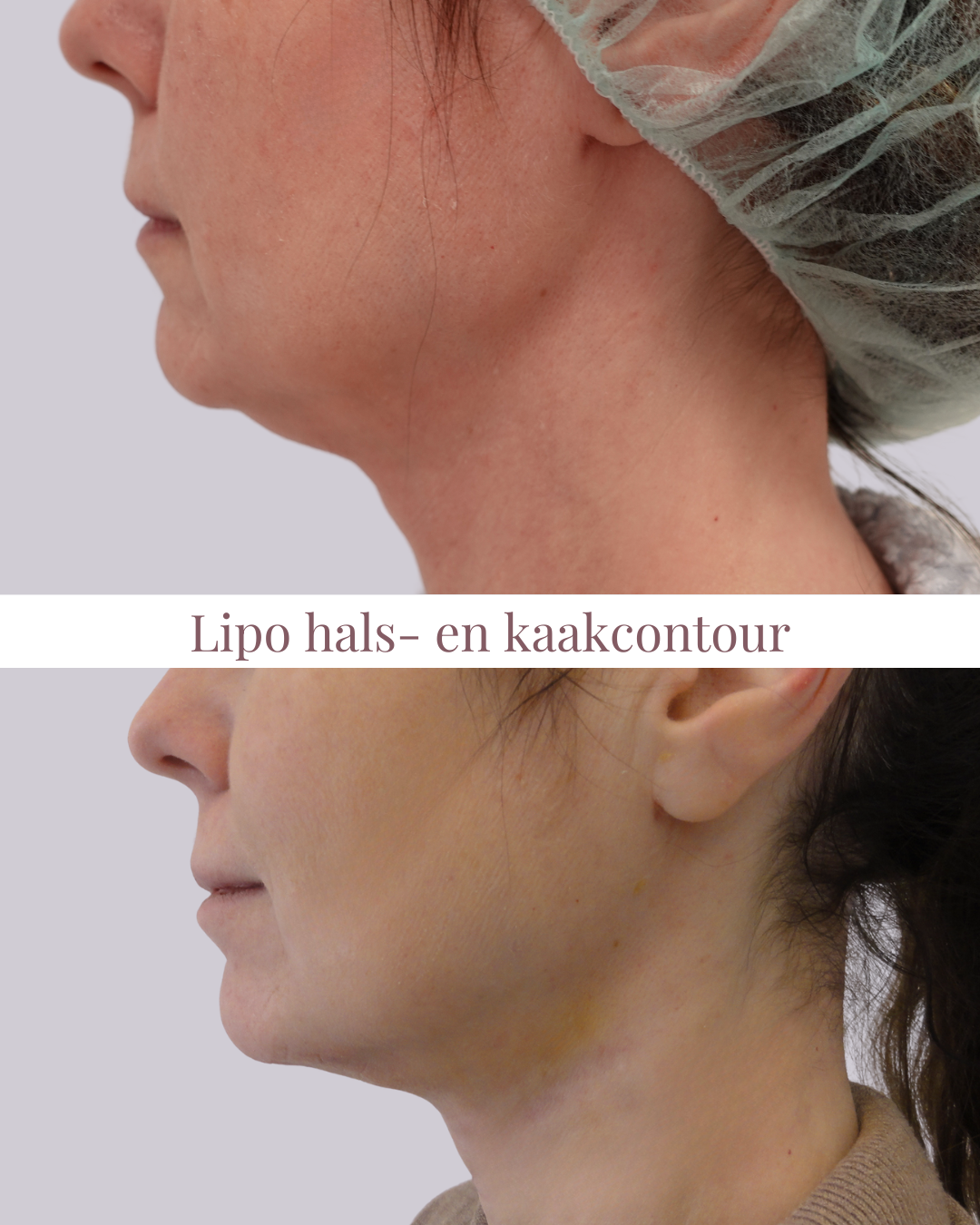 Before and after contouring treatment